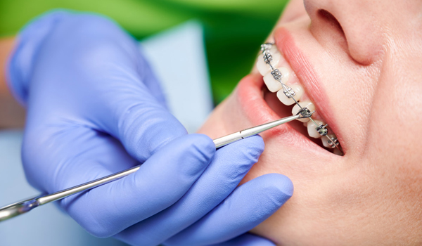 Orthodontics Teeth Alignment